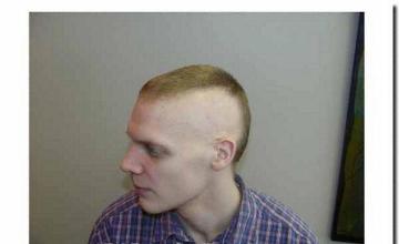 Hair restoration procedure results
