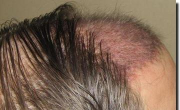 Hair restoration procedure results