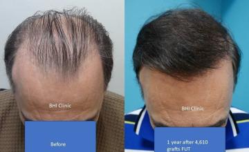 Front Before and After 
