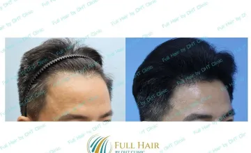 Before and After