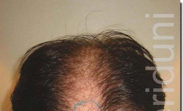 Hair restoration procedure results