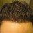 Beating-Hairloss